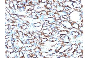 Formalin-fixed, paraffin-embedded human Angiosarcoma stained with Smooth Muscle Actin MAb (1A4 + ACTA2/791). (Smooth Muscle Actin 抗体  (N-Term))