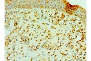 Immunohistochemistry of paraffin-embedded human prostate cancer using ABIN7147105 at dilution of 1:100 (CNOT8 抗体  (AA 1-292))