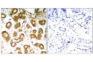 Immunohistochemical analysis of paraffin-embedded human breast carcinoma tissue using NFκB-p65 (Ab-505) Antibody (E021178). (NF-kB p65 抗体)