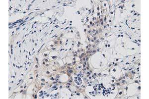Immunohistochemical staining of paraffin-embedded Carcinoma of Human pancreas tissue using anti-PRKD2 mouse monoclonal antibody. (PKD2 抗体)