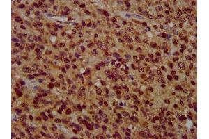 IHC image of ABIN7176659 diluted at 1:400 and staining in paraffin-embedded human glioma performed on a Leica BondTM system. (ZFX 抗体  (AA 711-805))