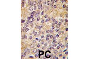 Formalin-fixed and paraffin-embedded human prostate carcinoma tissue reacted with PLAU polyclonal antibody  , which was peroxidase-conjugated to the secondary antibody, followed by DAB staining. (PLAU 抗体  (C-Term))