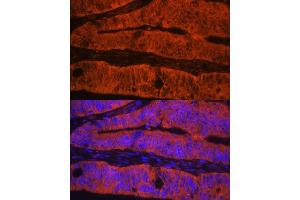 Immunofluorescence analysis of human colon carcinoma using TLN1 antibody (ABIN1683044, ABIN3018627, ABIN3018628 and ABIN6220520) at dilution of 1:100. (TLN1 抗体  (AA 1-220))