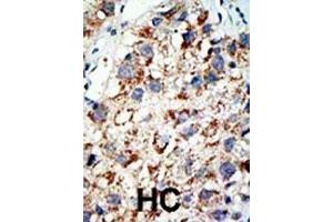 Formalin-fixed and paraffin-embedded human cancer tissue reacted with the primary antibody, which was peroxidase-conjugated to the secondary antibody, followed by AEC staining. (UBA2 抗体  (C-Term))