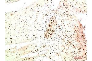 Immunohistochemical analysis of paraffin-embedded Human Colon Carcinoma Tissue using HP-1 α Mouse mAb diluted at 1:200. (CBX5 抗体)