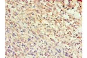 Immunohistochemistry of paraffin-embedded human melanoma using ABIN7145991 at dilution of 1:100 (CCL25 抗体  (AA 24-150))