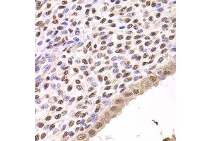Immunohistochemistry of paraffin-embedded human adenomyosis using FKBP4 Antibody. (FKBP4 抗体  (AA 220-459))