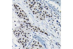 Immunohistochemistry of paraffin-embedded human lung cancer using A Rabbit pAb (ABIN6131196, ABIN6137102, ABIN6137103 and ABIN6223591) at dilution of 1:100 (40x lens). (ARID3A 抗体  (AA 324-593))