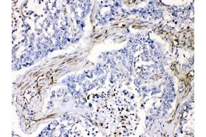 IHC testing of FFPE human lung cancer tissue with VASP antibody at 1ug/ml.