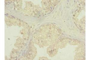 Immunohistochemistry of paraffin-embedded human prostate cancer using ABIN7174808 at dilution of 1:100 (C20orf195 抗体  (AA 10-310))