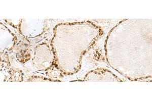 Immunohistochemistry of paraffin-embedded Human thyroid cancer tissue using GTF3C2 Polyclonal Antibody at dilution of 1:45(x200) (GTF3C2 抗体)