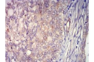 Immunohistochemical analysis of paraffin-embedded cervical cancer tissues using CD156 mouse mAb with DAB staining. (ADAM8 抗体  (AA 17-156))