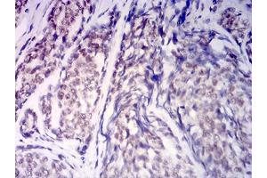 Immunohistochemical analysis of paraffin-embedded esophageal cancer tissues using KDM1A mouse mAb with DAB staining. (LSD1 抗体  (AA 709-876))