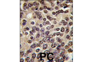 Formalin-fixed and paraffin-embedded human prostate carcinoma tissue reacted with PKN3 polyclonal antibody  , which was peroxidase-conjugated to the secondary antibody, followed by DAB staining. (PKN3 抗体  (C-Term))