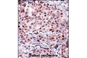 TERF2IP Antibody (C-term) ((ABIN657968 and ABIN2846914))immunohistochemistry analysis in formalin fixed and paraffin embedded human breast carcinoma followed by peroxidase conjugation of the secondary antibody and DAB staining. (RAP1 抗体  (C-Term))