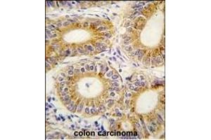 Formalin-fixed and paraffin-embedded human colon carcinoma tissue reacted with YARS2 antibody (C-term) (ABIN1882153 and ABIN2841956) , which was peroxidase-conjugated to the secondary antibody, followed by DAB staining. (YARS2 抗体  (C-Term))
