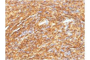 Formalin-fixed, paraffin-embedded human GIST stained with DOG-1 Mouse Monoclonal Antibody (DG1/1484). (ANO1 抗体  (AA 2-101))