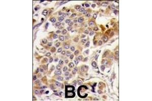 Formalin-fixed and paraffin-embedded human breast carcinoma tissue reacted with PRKp, which was peroxidase-conjugated to the secondary antibody, followed by DAB staining. (AMPK alpha 抗体  (AA 474-502))