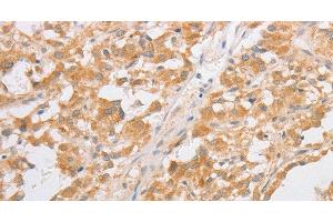 Immunohistochemistry of paraffin-embedded Human thyroid cancer tissue using CDKN2AIP Polyclonal Antibody at dilution 1:40 (CDKN2AIP 抗体)