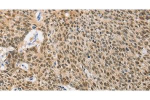 Immunohistochemistry of paraffin-embedded Human lung cancer using HSP40 Polyclonal Antibody at dilution of 1:40 (DNAJB1 抗体)