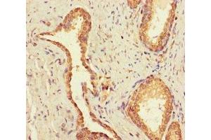 Immunohistochemistry of paraffin-embedded human prostate cancer using ABIN7174476 at dilution of 1:100