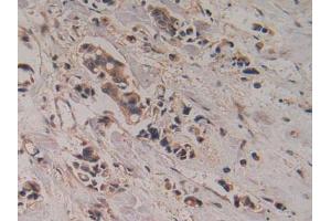 IHC-P analysis of CHuman Breast Cancer Tissue, with DAB staining. (CKMT1A 抗体  (AA 41-250))