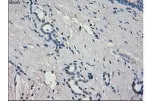 Immunohistochemical staining of paraffin-embedded Adenocarcinoma of breast tissue using anti-AURKC mouse monoclonal antibody.