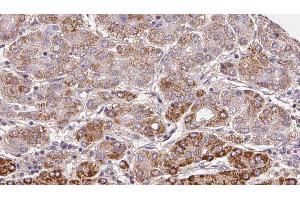 ABIN6272296 at 1/100 staining Human liver cancer tissue by IHC-P. (ELTD1 抗体  (Internal Region))