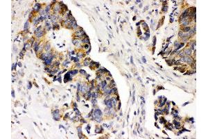 Anti- PDGFRA Picoband antibody, IHC(P) IHC(P): Human Intestinal Cancer Tissue (PDGFRA 抗体  (C-Term))