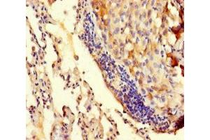 Immunohistochemistry of paraffin-embedded human lung cancer using ABIN7173512 at dilution of 1:100 (TRMT112 抗体  (AA 1-125))