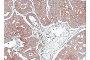 IHC-P Image Immunohistochemical analysis of paraffin-embedded Gastric CA N87 xenograft, using MPI, antibody at 1:100 dilution. (MPI 抗体)