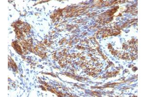 Formalin-fixed, paraffin-embedded human Leiomyosarcoma stained with Caldesmon Mouse Monoclonal Antibody (CALD1/820). (Caldesmon 抗体)