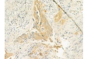 ABIN6261506 and ABIN6272997 at 1/100 staining human lung squamous cell carcinoma by IHC-P.
