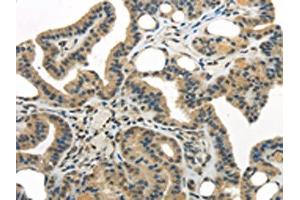 The image on the left is immunohistochemistry of paraffin-embedded Human thyroid cancer tissue using ABIN7193040(WDR36 Antibody) at dilution 1/35, on the right is treated with synthetic peptide. (WDR36 抗体)