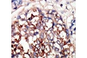 IHC analysis of FFPE human hepatocarcinoma tissue stained with the DYRKB antibody (DYRK1B 抗体  (AA 561-589))