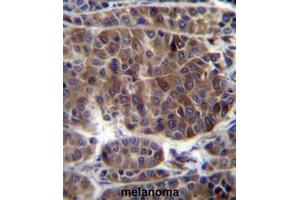 PRAMEF3 Antibody (C-term) immunohistochemistry analysis in formalin fixed and paraffin embedded human melanoma followed by peroxidase conjugation of the secondary antibody and DAB staining. (PRAMEF3 抗体  (C-Term))
