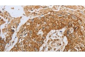 Immunohistochemistry of paraffin-embedded Human esophagus cancer using CKM Polyclonal Antibody at dilution of 1:50 (CKM 抗体)