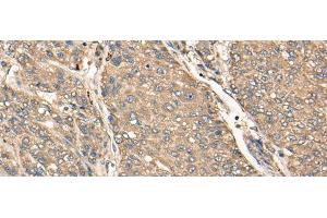 Immunohistochemistry of paraffin-embedded Human liver cancer tissue using C17orf67 Polyclonal Antibody at dilution of 1:50(x200) (C17ORF67 抗体)