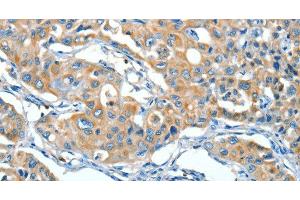 Immunohistochemistry (Paraffin-embedded Sections) (IHC (p)) image for anti-serpin Peptidase Inhibitor, Clade A (Alpha-1 Antiproteinase, Antitrypsin), Member 3 (SERPINA3) antibody (ABIN7235795)