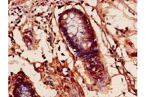 Immunohistochemistry of paraffin-embedded human colon cancer using ABIN7164206 at dilution of 1:100 (PFDN1 抗体  (AA 2-122))