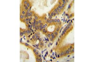CC85C Antibody (N-term) (ABIN654469 and ABIN2844203) immunohistochemistry analysis in formalin fixed and paraffin embedded human prostate carcinoma followed by peroxidase conjugation of the secondary antibody and DAB staining.