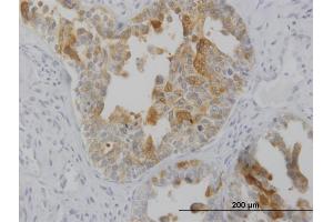 Immunoperoxidase of monoclonal antibody to LMTK2 on formalin-fixed paraffin-embedded human ovarian cancer. (LMTK2 抗体  (AA 1181-1280))