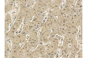 SLC47A2 Mouse Monoclonal Antibody at 1/100 staining human liver cancer and adjacent non-tumor tissue by IHC-P. (SLC47A2 抗体)