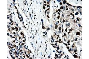 Immunohistochemical staining of paraffin-embedded Adenocarcinoma of ovary tissue using anti-PSMC3mouse monoclonal antibody. (PSMC3 抗体)