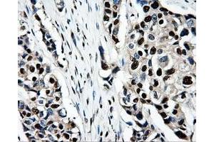 Immunohistochemical staining of paraffin-embedded Adenocarcinoma of ovary tissue using anti-PSMC3mouse monoclonal antibody. (PSMC3 抗体)
