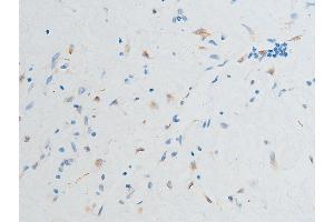ABIN6267252 at 1/100 staining human glioma tissue sections by IHC-P. (CHEK2 抗体  (pSer516))