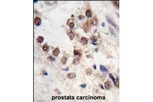 Formalin-fixed and paraffin-embedded human prostata carcinoma tissue reacted with KLF4 antibody (N-term C74) (ABIN389187 and ABIN2839350) , which was peroxidase-conjugated to the secondary antibody, followed by DAB staining.