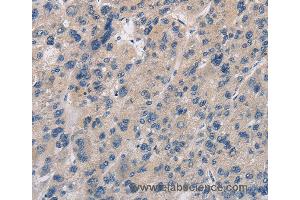 Immunohistochemistry of Human liver cancer using IMPDH1 Polyclonal Antibody at dilution of 1:20 (IMPDH1 抗体)