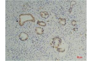 Immunohistochemistry (IHC) analysis of paraffin-embedded Human Pancreatic Carcinoma using Cyclophilin B Mouse Monoclonal Antibody diluted at 1:200. (PPIB 抗体)