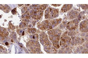 ABIN6273395 at 1/100 staining Human liver cancer tissue by IHC-P. (SCN3A 抗体  (Internal Region))